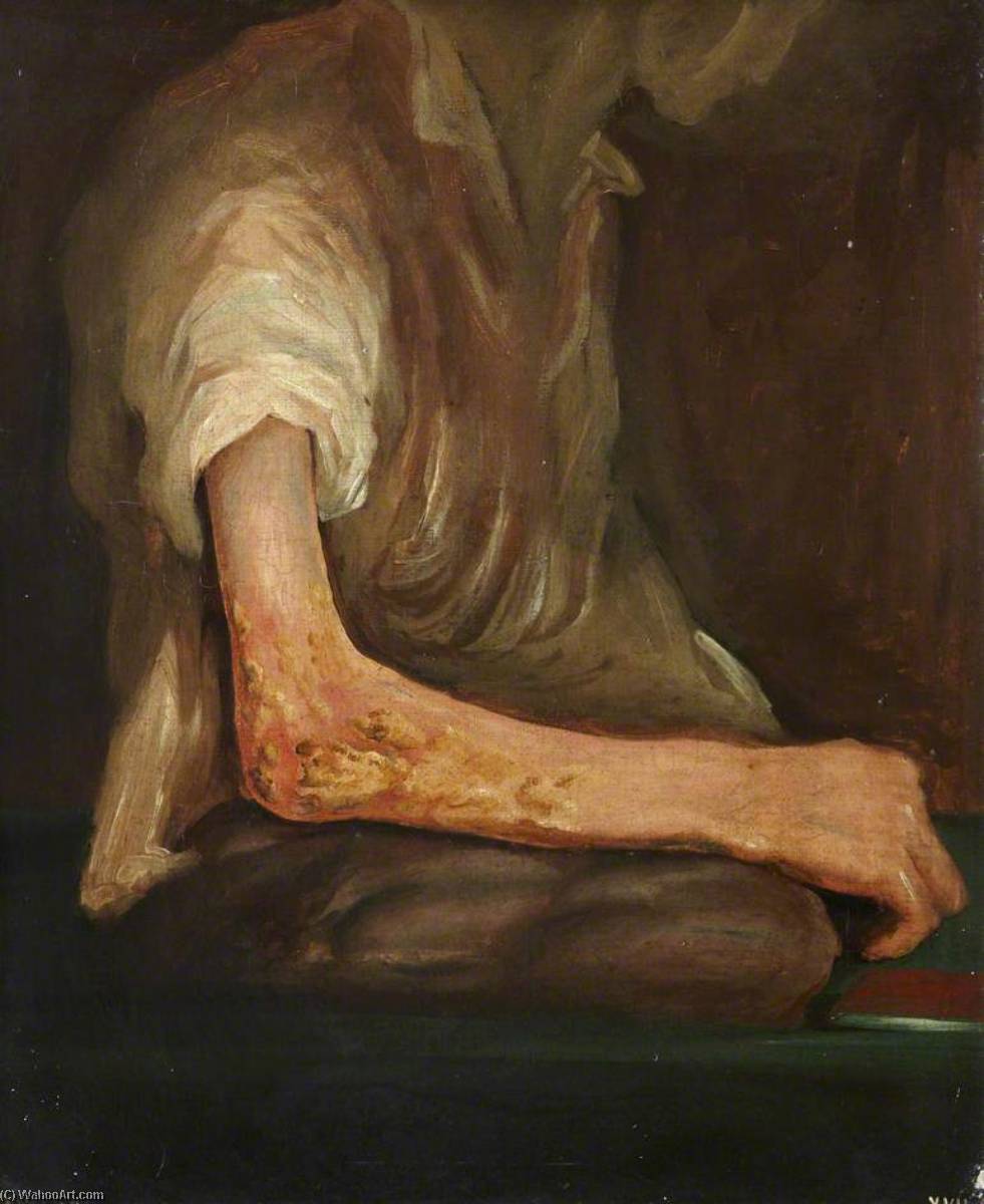 The Wounded Following The Battle Of Corunna Musket Ball Wound Of Elbow — Čarls Bel