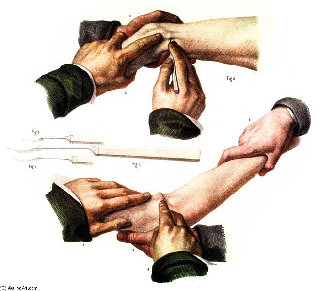 Tendon Transection For The Treatment Of Muscle Spasm In The Thigh — Nicolas Henri Jacob