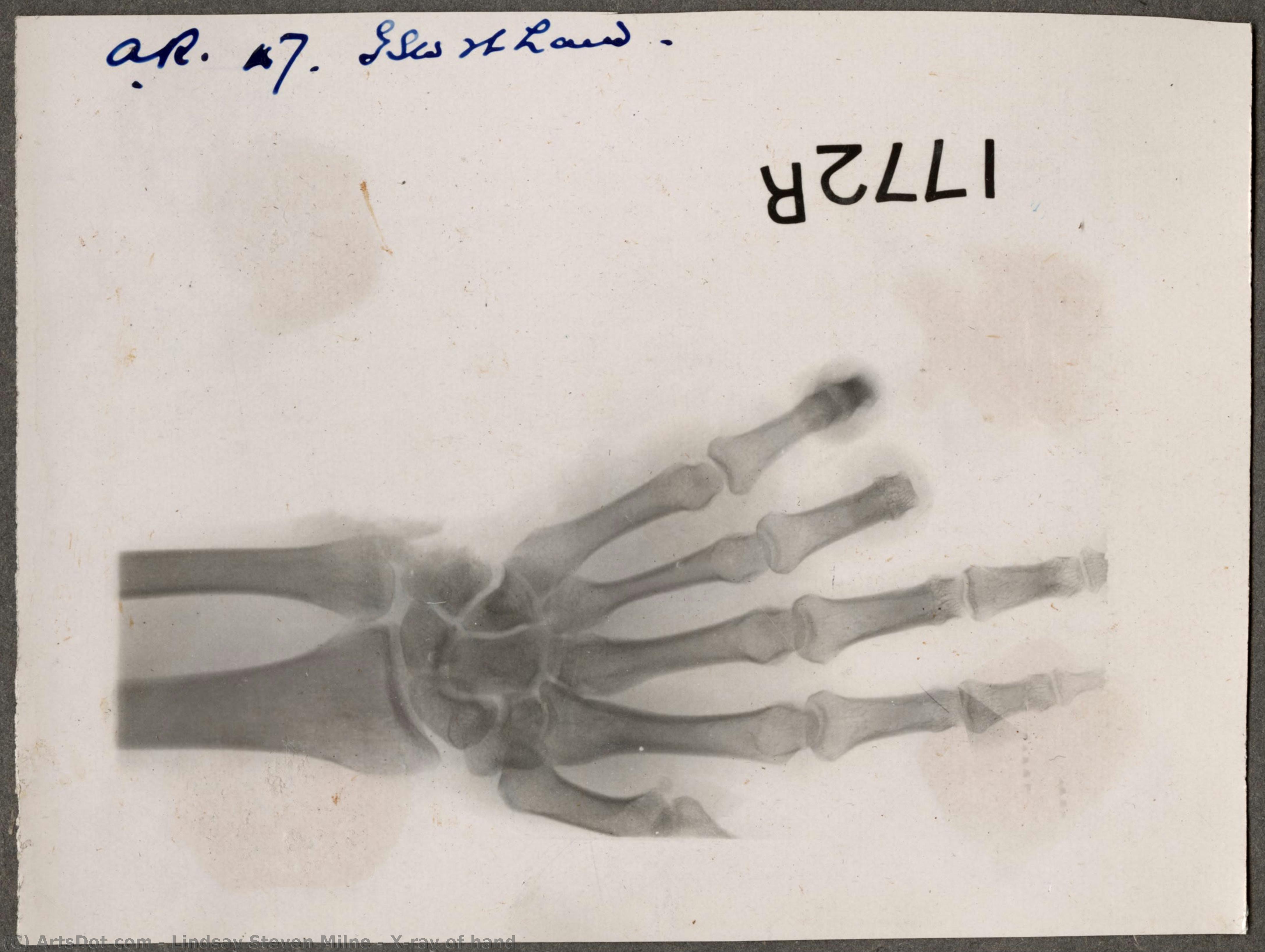 X-ray Of Hand — Lindsay Steven Milne