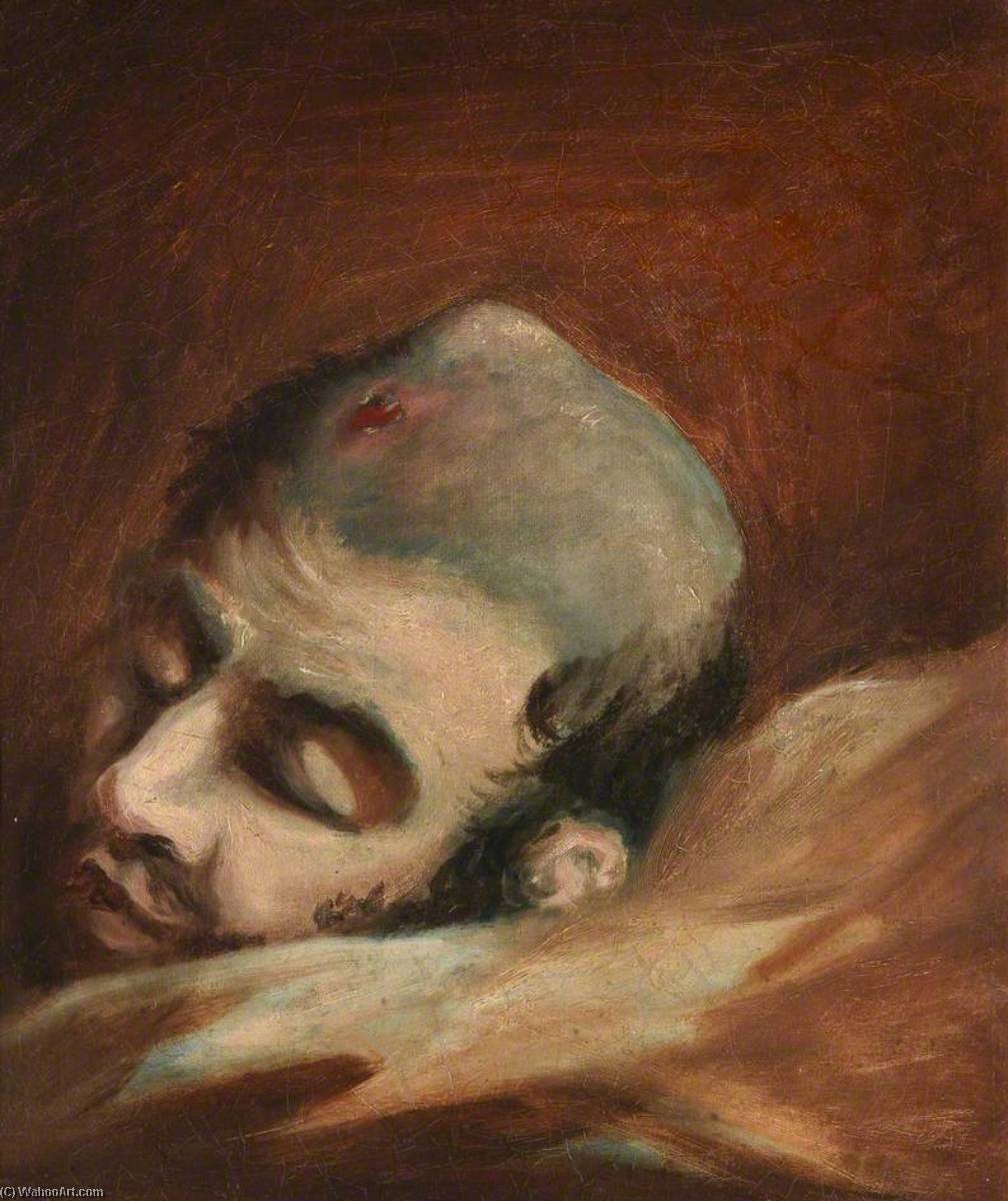 The Wounded Following The Battle Of Corunna Bullet Wound Of Skull — Čarls Bel