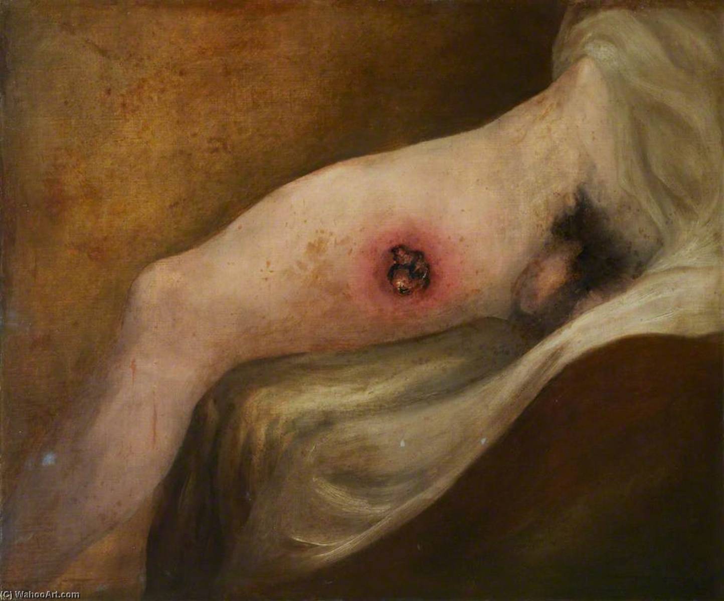 The Wounded Following The Battle Of Corunna Gunshot Wound Of Thigh — Čarls Bel