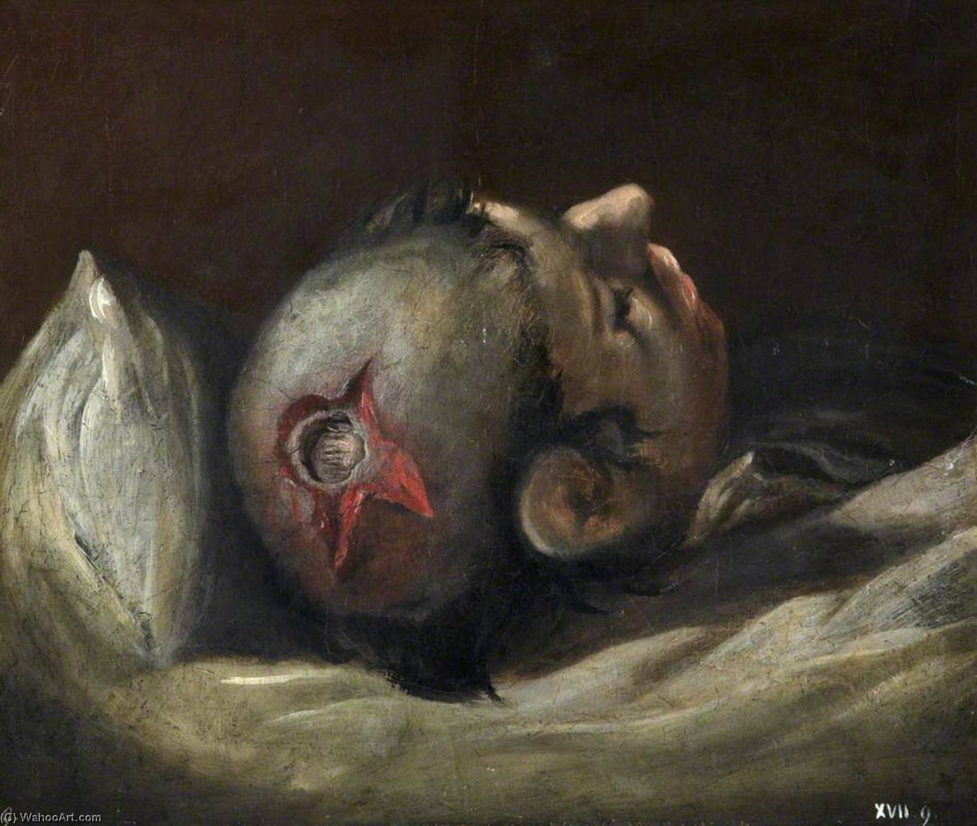 The Wounded Following The Battle Of Corunna Musket Ball Wound Of Skull — Čarls Bel