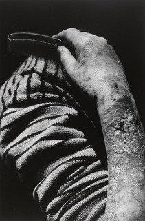 Hibakusha Fukuda Sumako, Nagasaki — Shomei Tomatsu