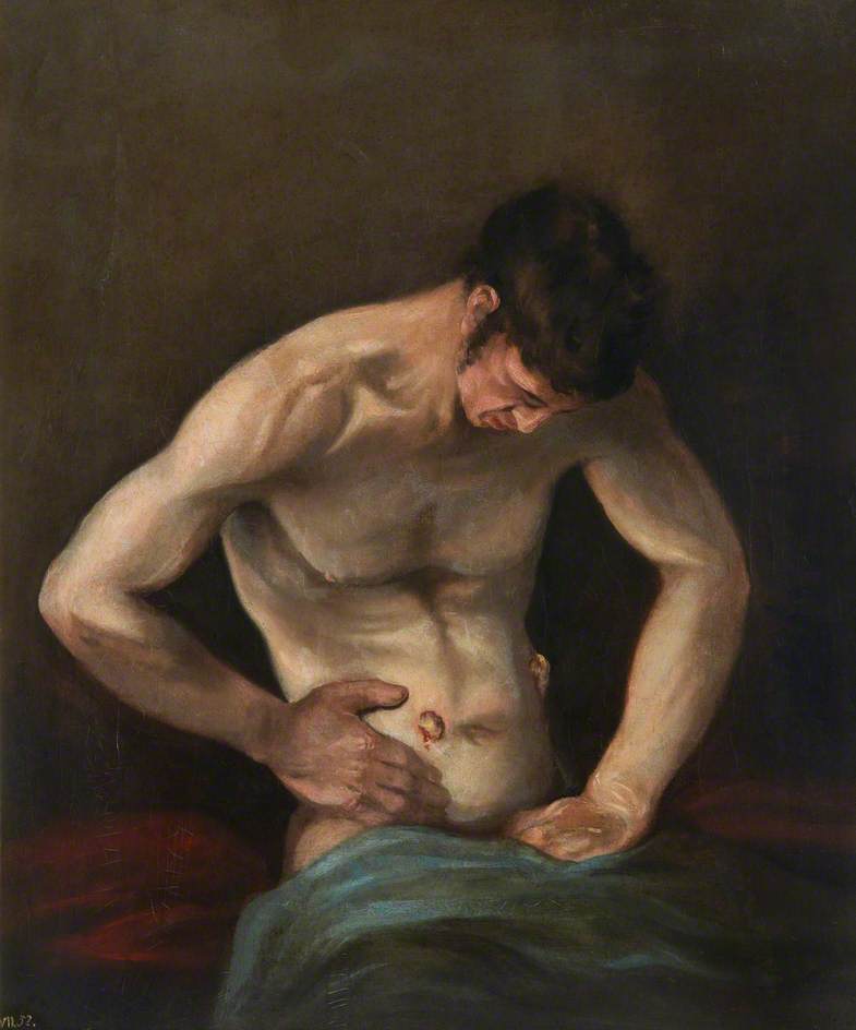 The Wounded Following The Battle Of Corunna Gunshot Wound Of Abdomen — Charles Bell