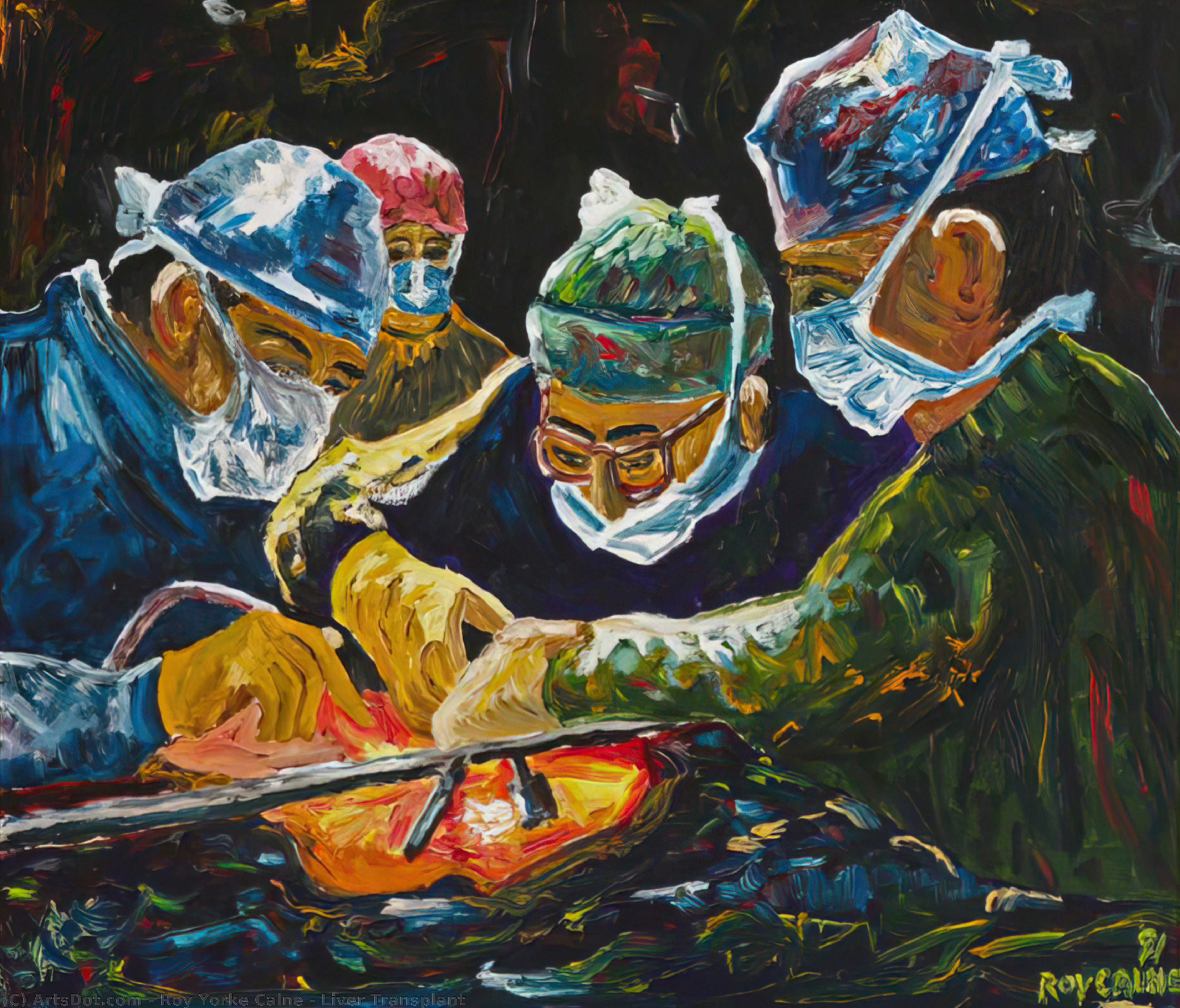 Liver Transplant — Roy Yorke Calne
