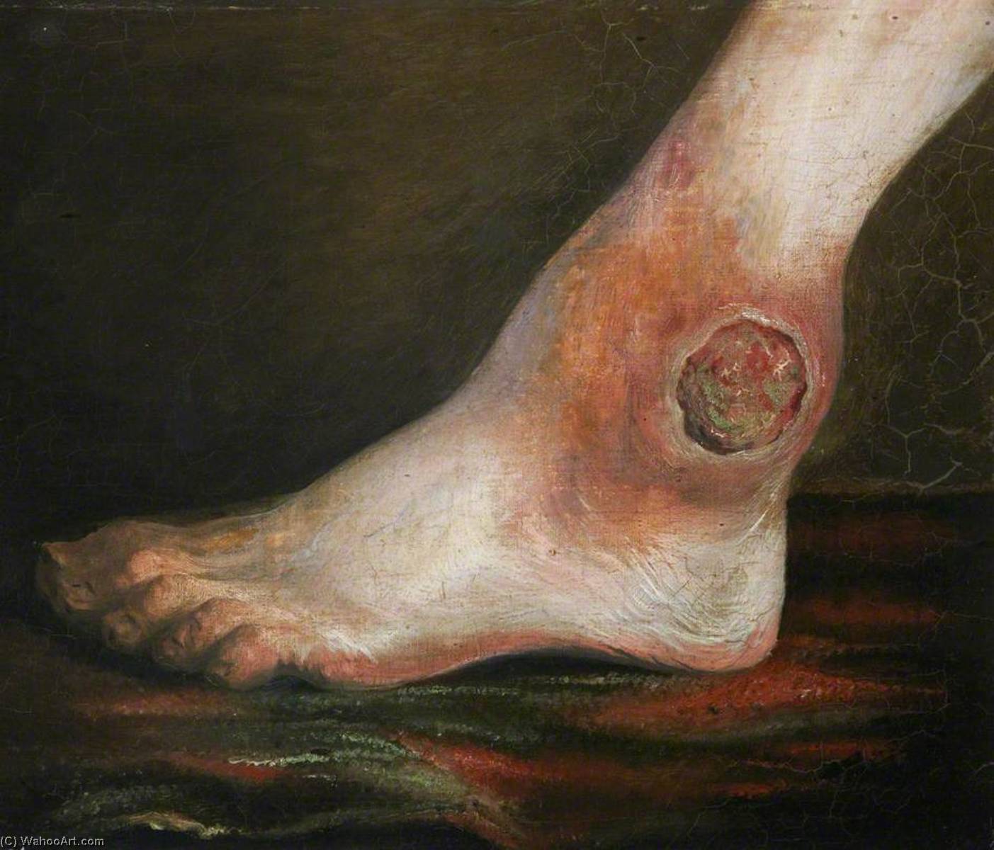 The Wounded Following The Battle Of Corunna Gunshot Wound Of Ankle Joint — Charles Bell