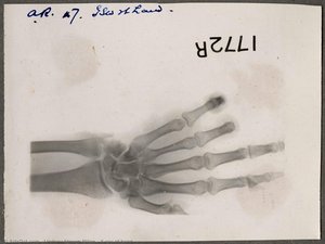 X-ray Of Hand — Lindsay Steven Milne
