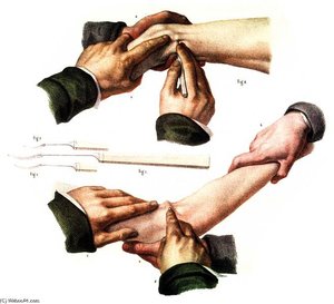 Tendon Transection For The Treatment Of Muscle Spasm In The Thigh