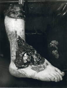 Untitled (amputated Foot) — Frederick Sommer
