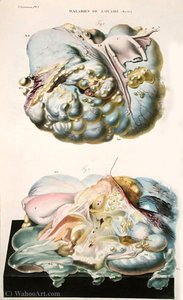 Diseases Of The Ovaries, From 'anatomie Pathologique Du Corps Humain' — Antoine Chazal