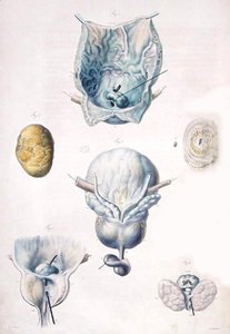 Diseases of the bladder and prostate, from 'Anatomie Pathologique du Corps Humain'